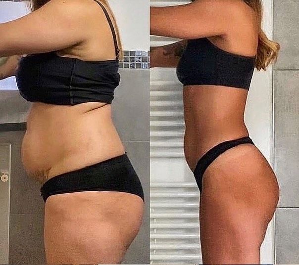 Antes - Paciente 29 anos